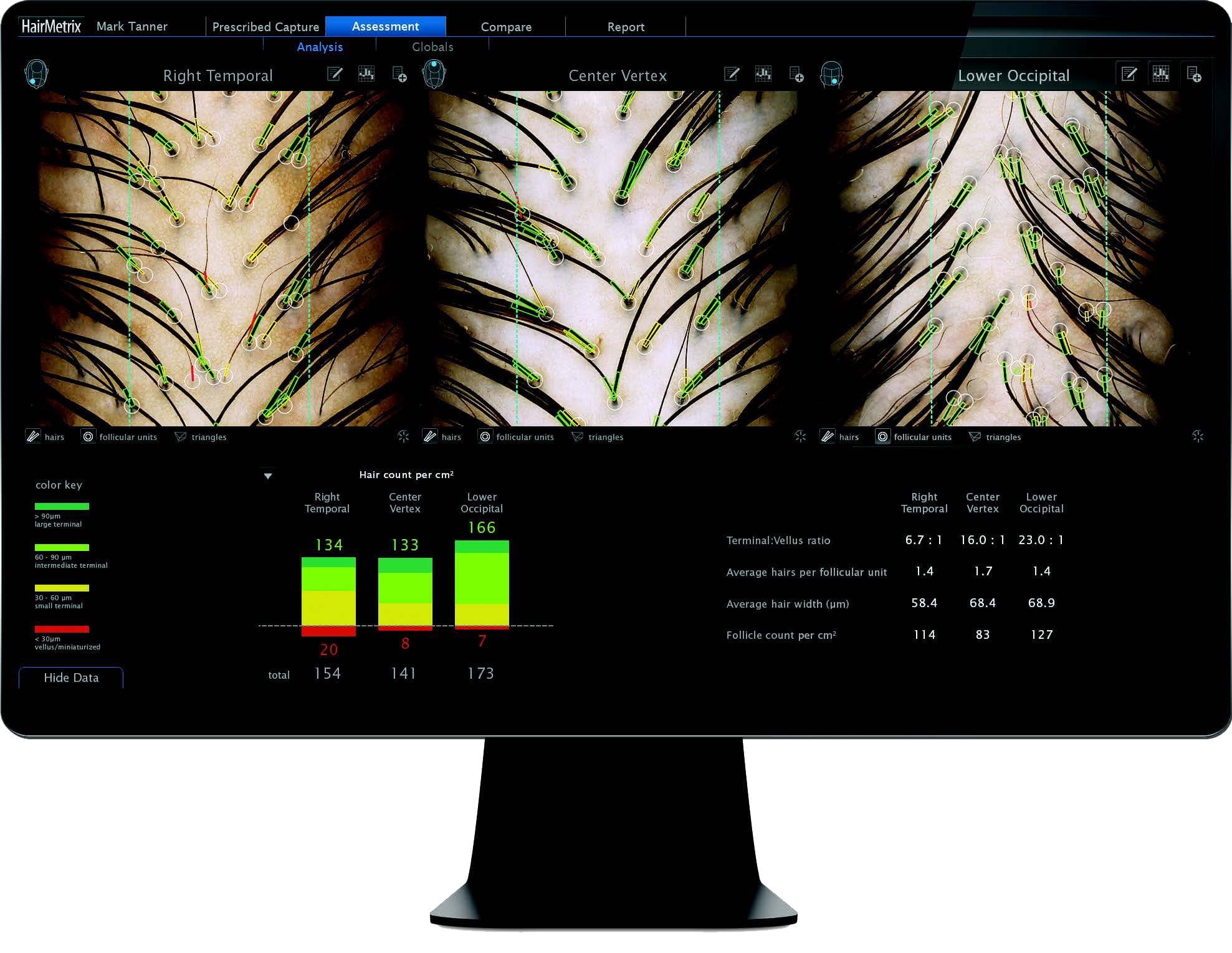 Hair Metrix Screen Shot folix report
