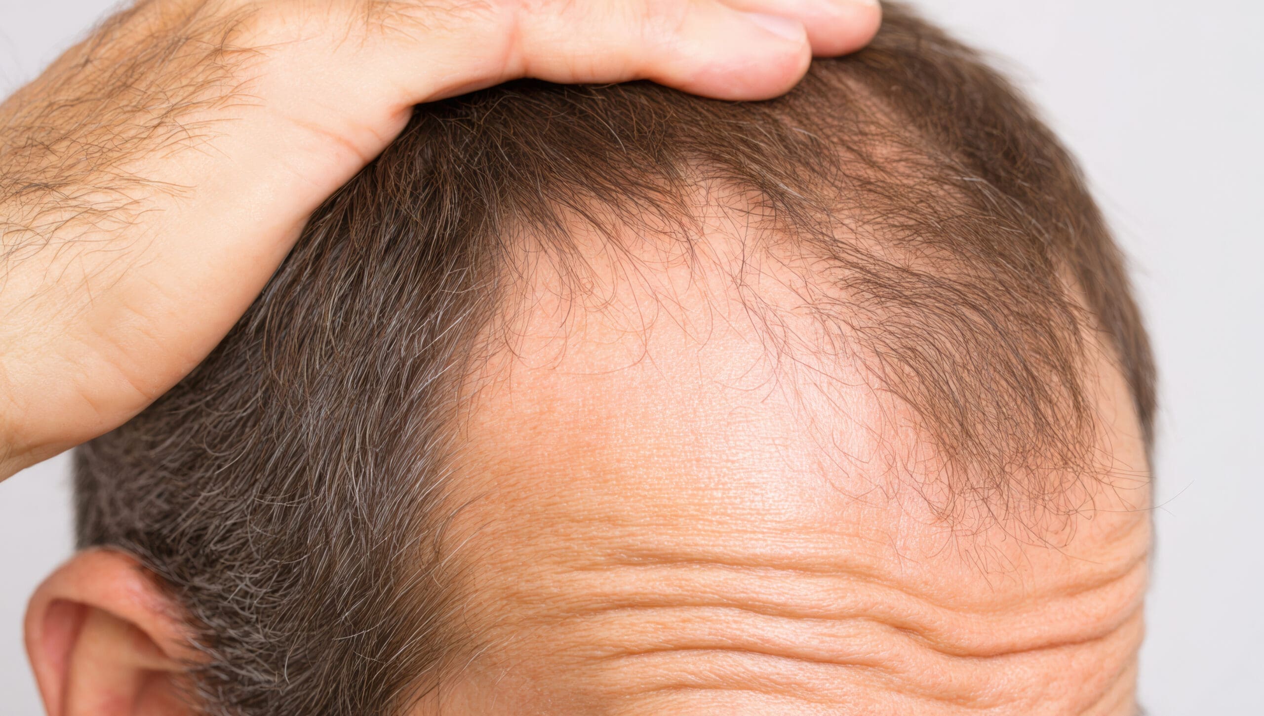 Seattle Hair Loss Clinic image of a young man observing his thinning hair and balding scalp, searching for solutions for hair loss and alopecia