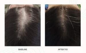 Seattle Hair Loss Clinic -Folix Before And After images