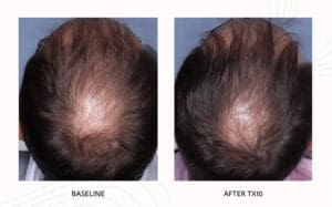 Seattle Hair Loss Clinic -Folix Before And After images