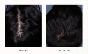 Seattle Hair Loss Clinic -Folix Before And After images