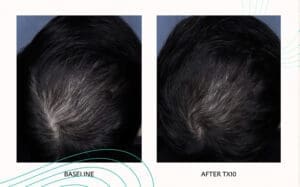 Seattle Hair Loss Clinic -Folix Before And After images