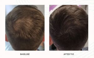 Seattle Hair Loss Clinic -Folix Before And After images