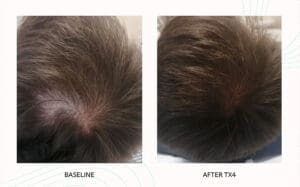 Seattle Hair Loss Clinic -Folix Before And After images