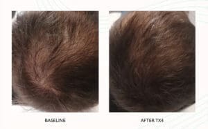 Seattle Hair Loss Clinic -Folix Before And After images