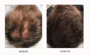 Seattle Hair Loss Clinic -Folix Before And After images