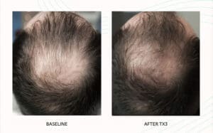 Seattle Hair Loss Clinic -Folix Before And After images
