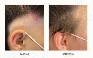 Seattle Hair Loss Clinic -Folix Before And After images