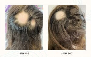 Seattle Hair Loss Clinic -Folix Before And After images