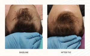 Seattle Hair Loss Clinic -Folix Before And After images