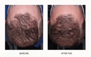 Seattle Hair Loss Clinic -Folix Before And After images