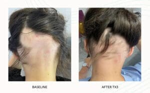 Seattle Hair Loss Clinic -Folix Before And After images