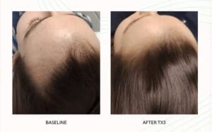 Seattle Hair Loss Clinic -Folix Before And After images