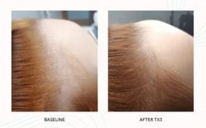 Seattle Hair Loss Clinic -Folix Before And After images