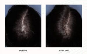 Seattle Hair Loss Clinic -Folix Before And After images