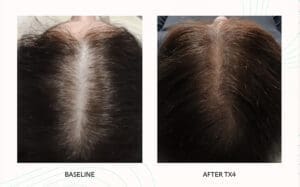 Seattle Hair Loss Clinic -Folix Before And After images