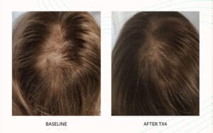Seattle Hair Loss Clinic -Folix Before And After images