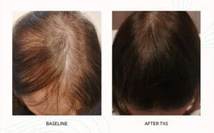 Seattle Hair Loss Clinic -Folix Before And After images