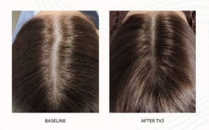 Seattle Hair Loss Clinic -Folix Before And After images
