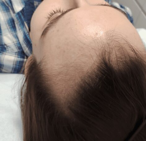 Seattle Hair Loss Clinic image showing a man with a thinning hair line
