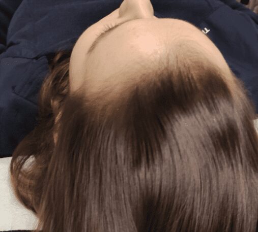 Seattle Hair Loss Clinic image of Hair improvements - showing a man with improved hair line